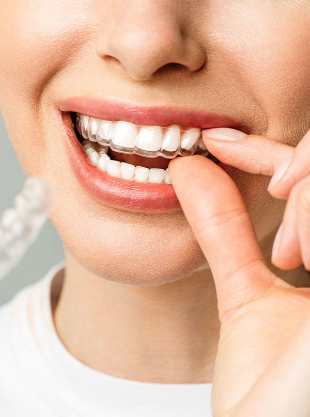 Aparate Dentare-640x860px