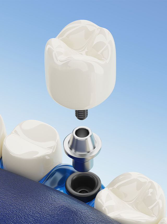 Implante-Dentare-640x860px